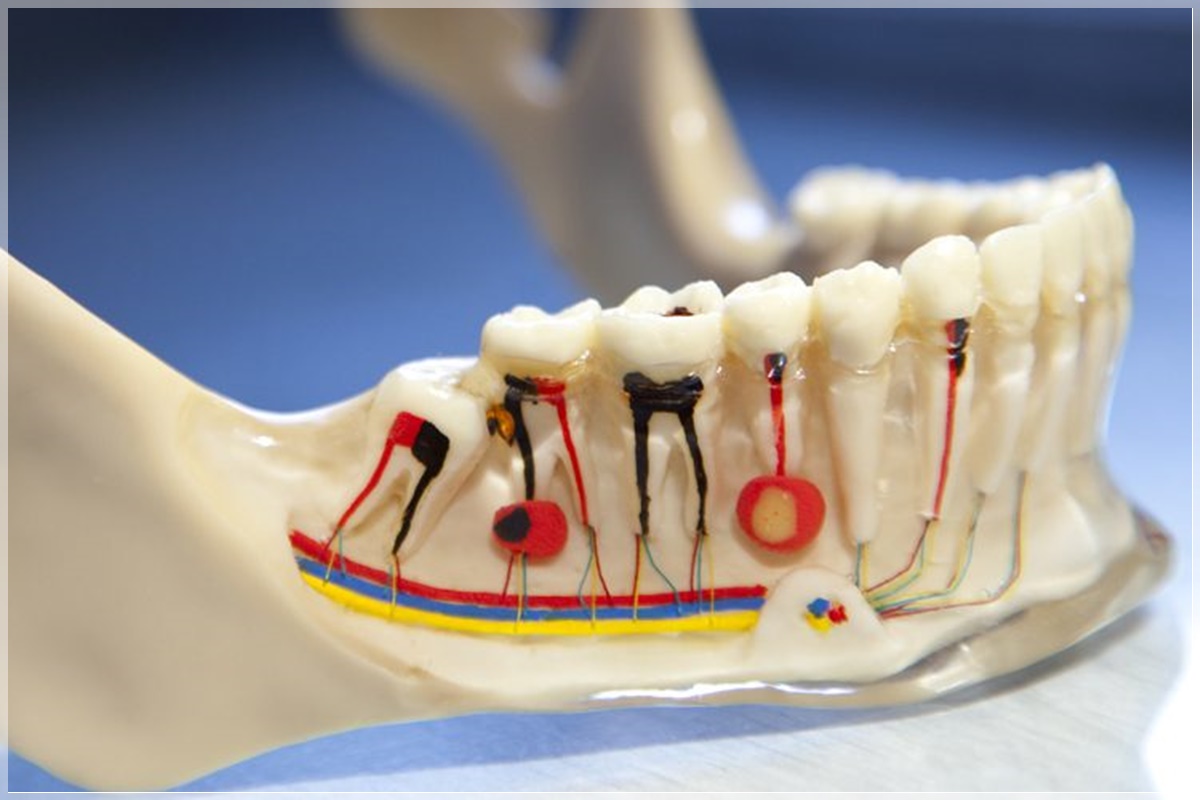 Endodonti - Kanal Tedavisi