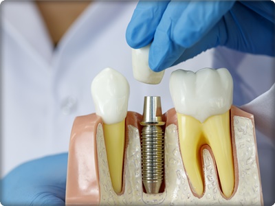 Implant fiyatları ne kadar?