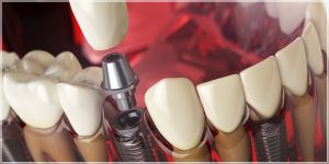 etiler implant